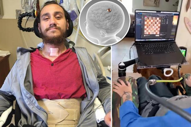 NEURALINK / Giovane paralizzato muove gli scacchi con il pensiero